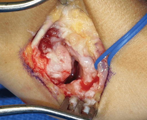 Intra-operative trapeziectomy exposure