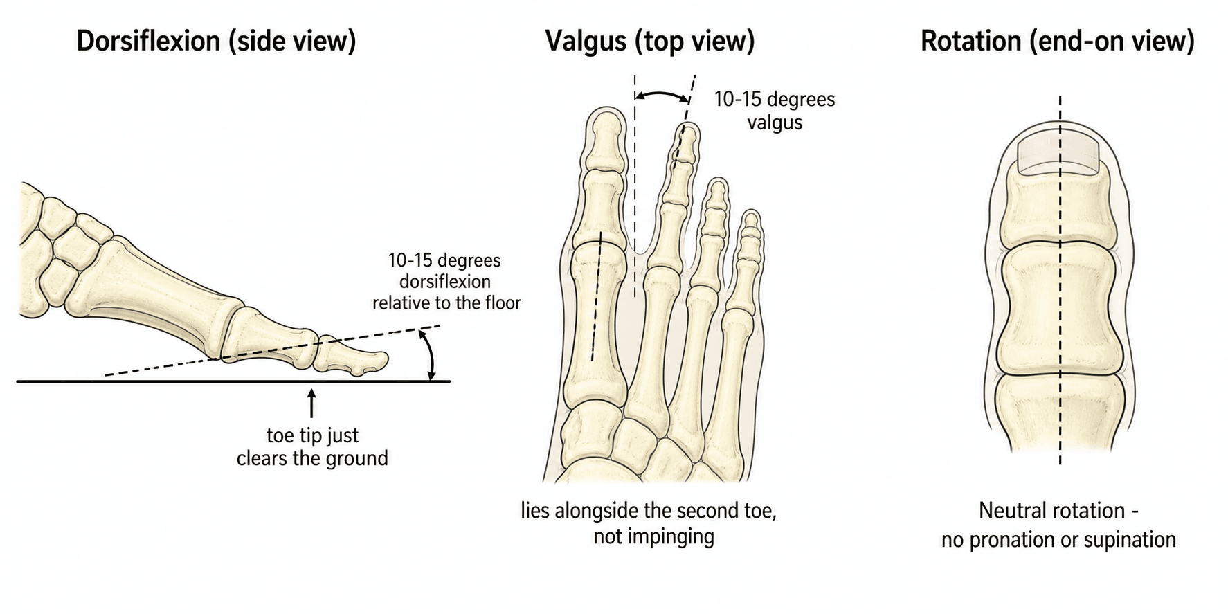 Diagram of the correct fusion position for a first MTP arthrodesis: dorsiflexion, valgus and neutral rotation.