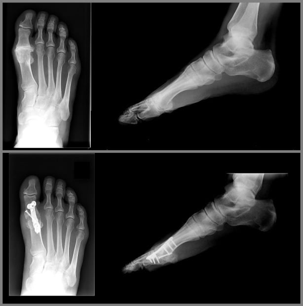 Hallux rigidus arthrodesis with cup-and-cone preparation