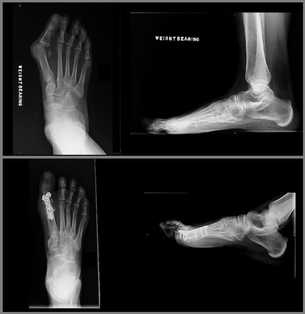 Hallux valgus correction with first MTP arthrodesis