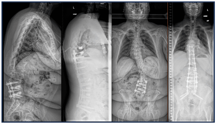 Four radiographs: a lateral and a frontal film with a short lumbosacral construct, and a lateral and a frontal film with a long construct from the thoracic spine to the pelvis