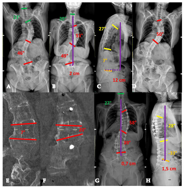Eight-panel figure A to H: preoperative frontal and lateral standing radiographs with Cobb angles, a 2 cm coronal offset and a 12 cm sagittal offset printed; two sagittal CT slices with 7-degree and 20-degree angles; postoperative frontal and lateral radiographs with a long instrumented construct and offsets of 0.7 cm and 1.5 cm