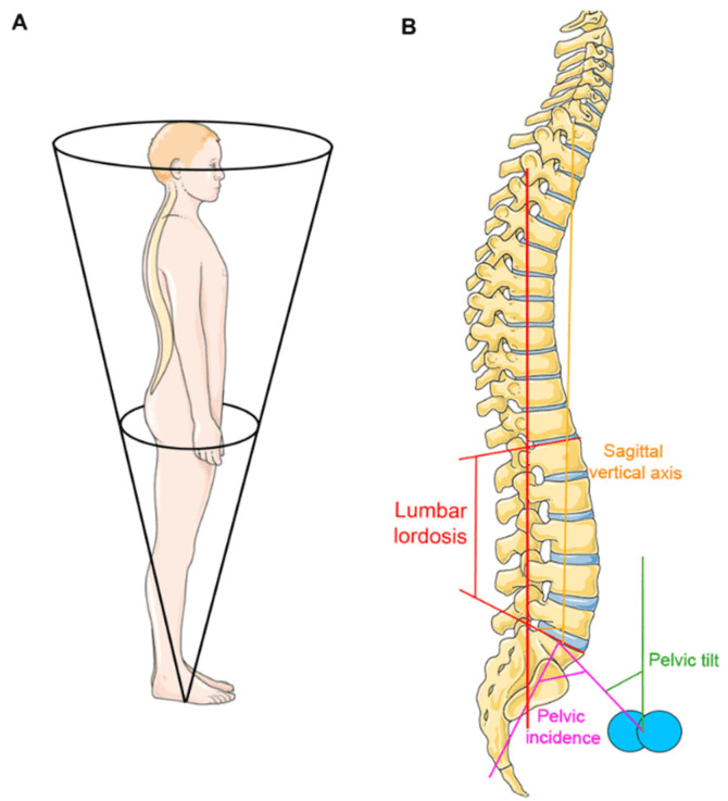 Two-panel figure: A, a standing figure drawn inside an inverted cone; B, a lateral spine drawing with lumbar lordosis, sagittal vertical axis, pelvic incidence and pelvic tilt labelled