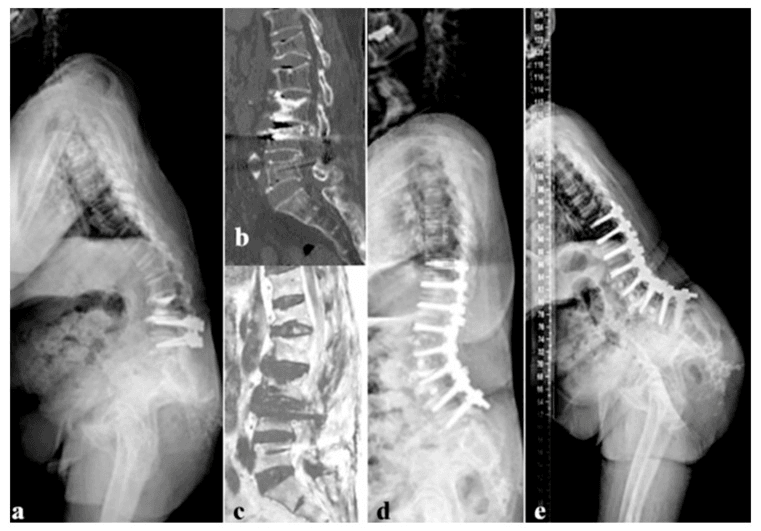 Five panels a to e: a standing lateral radiograph of a long posterior construct ending in the lower lumbar spine, a sagittal CT and a sagittal MRI through the lumbosacral segment below it, and two later lateral radiographs, the last with instrumentation carried further down