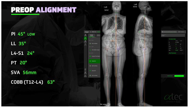 Preoperative alignment report: printed values PI 45 degrees (low), LL 35 degrees, L4-S1 24 degrees, PT 20 degrees, SVA 56 mm and a Cobb angle of 63 degrees, beside frontal and lateral whole-body standing radiographs