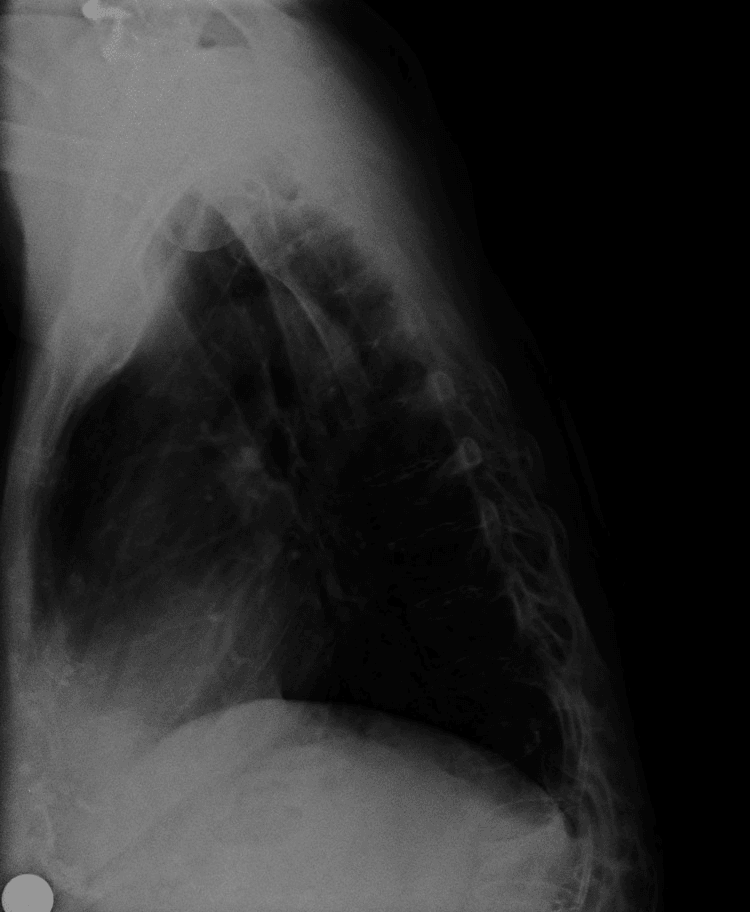 Lateral radiograph of the thorax showing the thoracic spine in profile behind the lung fields, with the lumbar spine and pelvis outside the field