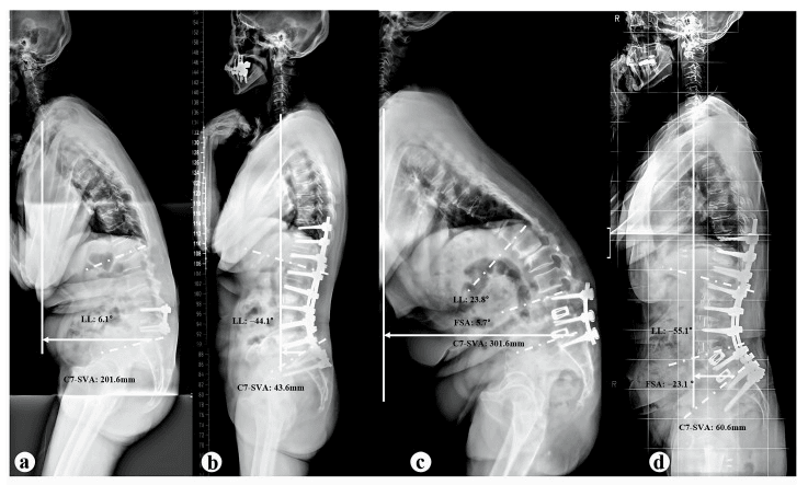 Four lateral standing radiographs labelled a to d with printed values: a, LL 6.1 degrees and C7-SVA 201.6 mm with a short lumbar construct; b, LL -44.1 degrees and C7-SVA 43.6 mm with a long lumbosacral construct; c, LL 23.8 degrees and C7-SVA 301.6 mm; d, LL -55.1 degrees and C7-SVA 60.6 mm