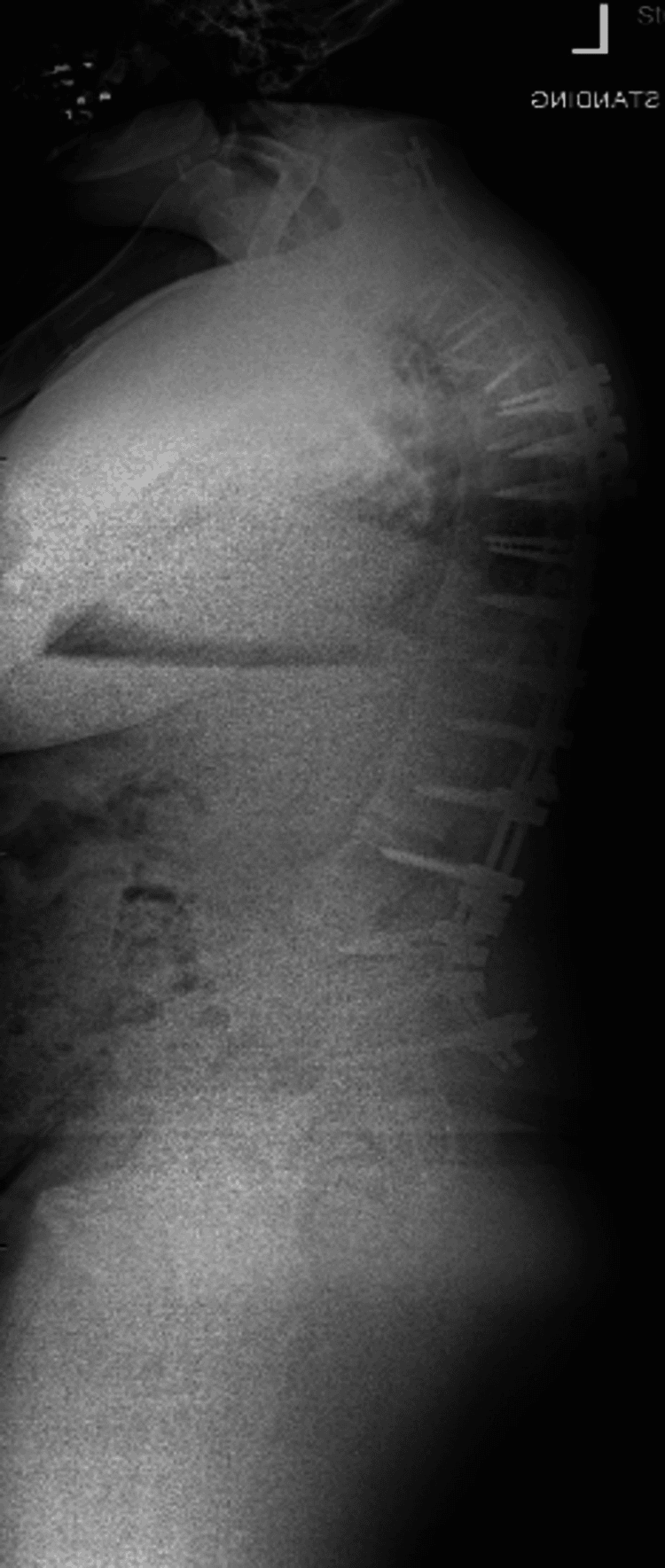 Standing lateral radiograph, with STANDING printed at the top corner, showing a long posterior construct running through the lumbar spine