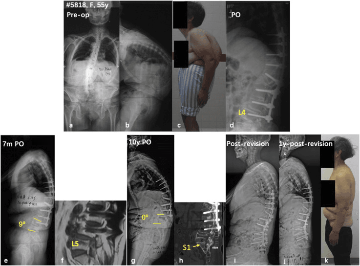 Eleven panels a to k of a 55-year-old woman per the printed labels: preoperative frontal and lateral radiographs and a stooped clinical photograph; a postoperative lateral with L4 arrowed; a 7-month lateral with a 9-degree angle and an MRI with L5 marked; a 10-year lateral with a 0-degree angle and a CT with S1 arrowed; post-revision and one-year lateral films and a standing clinical photograph