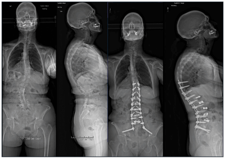 Four whole-body standing radiographs: preoperative frontal and lateral, then postoperative frontal and lateral with a long posterior screw-and-rod construct from the thoracic spine to the pelvis
