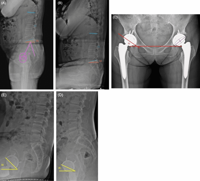 Five radiographs labelled A to E: two lateral lumbopelvic films with lumbar lordosis and sacral slope marked and pelvic incidence drawn, an anteroposterior pelvis after bilateral hip replacement with a line labelled RI, and two lateral films with an angle labelled AI at the acetabular component