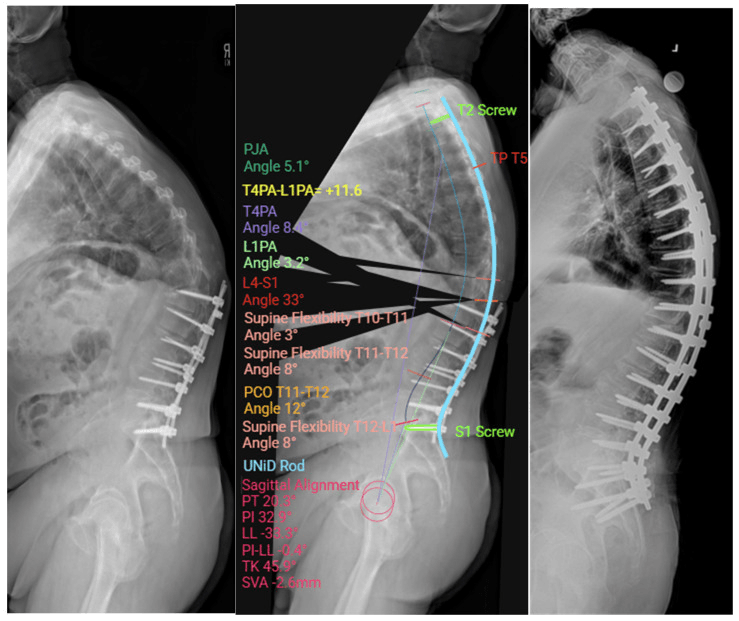 Three lateral radiographs: proximal junctional kyphosis above a lumbar construct; a planning overlay with a proposed rod drawn from a T2 screw to an S1 screw and printed alignment values; the postoperative film with a long construct from the upper thoracic spine to the pelvis