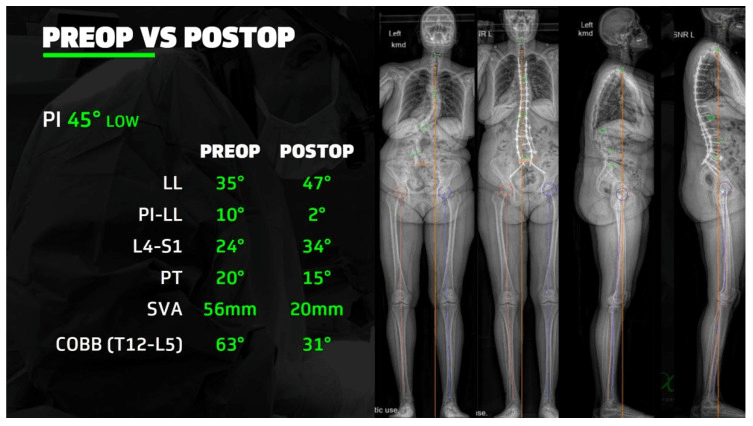 Preop versus postop alignment report: PI 45 degrees; LL 35 to 47 degrees, PI-LL 10 to 2 degrees, L4-S1 24 to 34 degrees, PT 20 to 15 degrees, SVA 56 to 20 mm, Cobb 63 to 31 degrees, beside preoperative and postoperative whole-body frontal and lateral radiographs