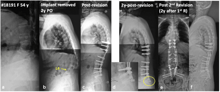 Six panels a to f of a 54-year-old woman per the printed labels: an initial lateral radiograph; a lateral two years after implant removal with L4 arrowed; a post-revision lateral; a lateral two years after revision with the lower end of the construct circled in yellow; frontal and lateral films after a second revision