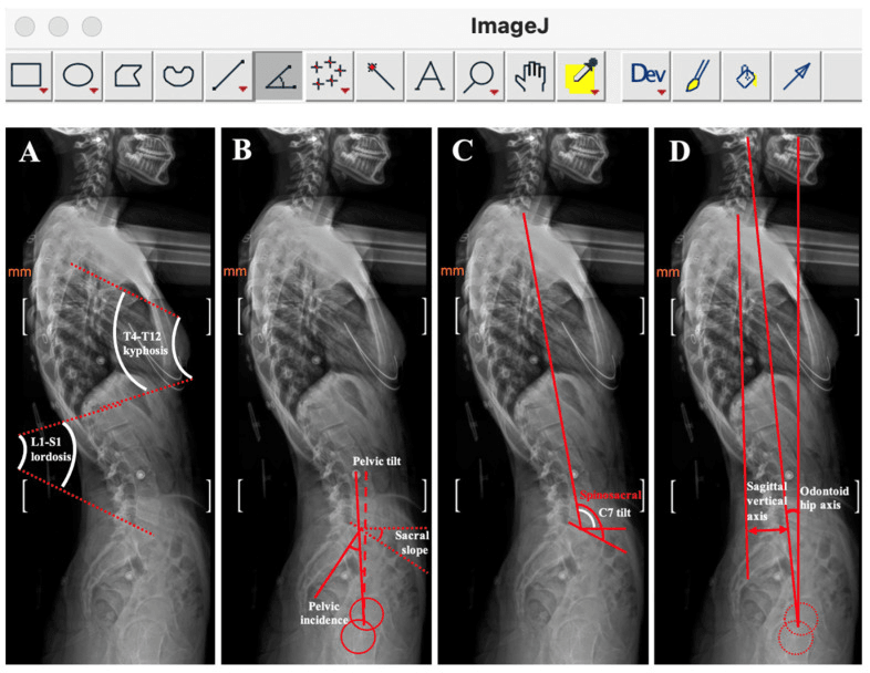 Four-panel lateral radiograph montage in ImageJ labelled A to D: thoracic kyphosis and lumbar lordosis; pelvic tilt, sacral slope and pelvic incidence; spinosacral angle and C7 tilt; sagittal vertical axis and odontoid-hip axis, all drawn in red