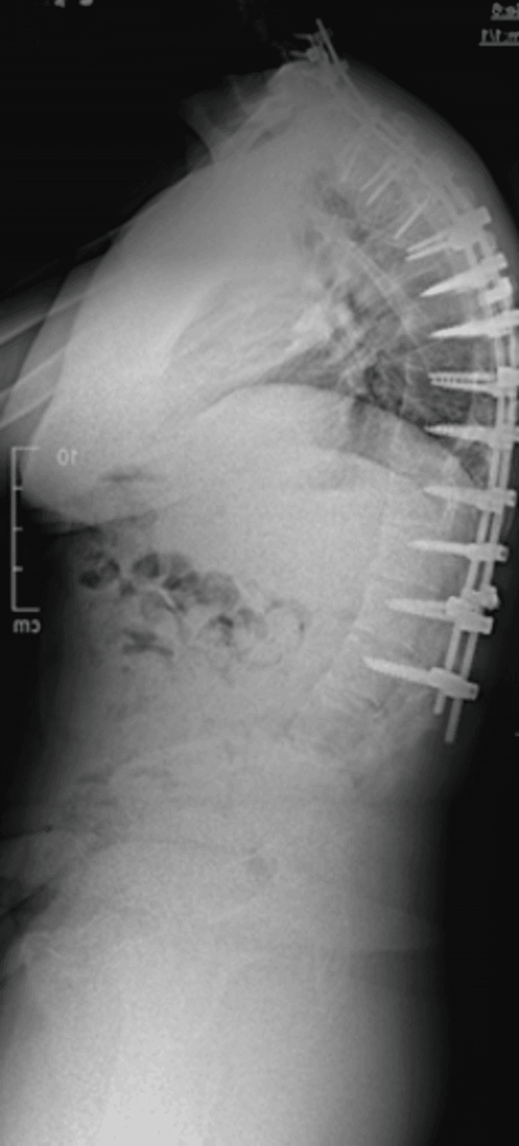 Lateral radiograph of the thoracolumbar spine with a long posterior pedicle-screw and rod construct and a 10 cm scale bar at the left edge