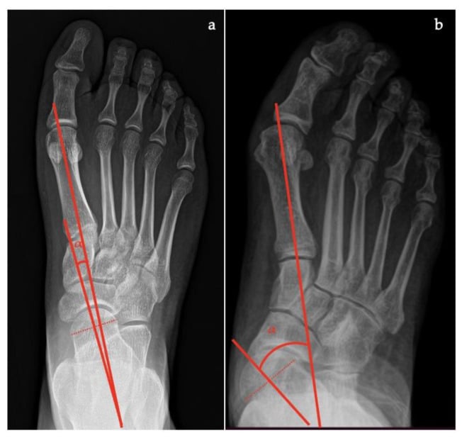 Normal and pathological weight-bearing AP foot radiographs demonstrating the talo-first metatarsal angle