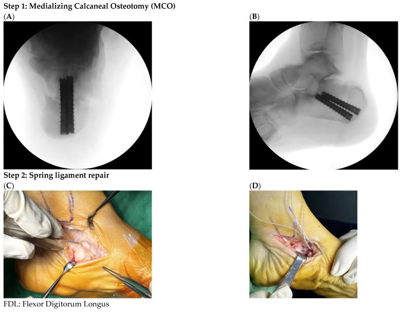 Stepwise operative and fluoroscopic images of medialising calcaneal osteotomy spring ligament repair FDL transfer and adjunct correction