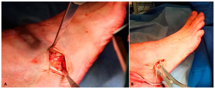 Operative sinus tarsi approach for lateral calcaneal lengthening with protected peroneal tendons