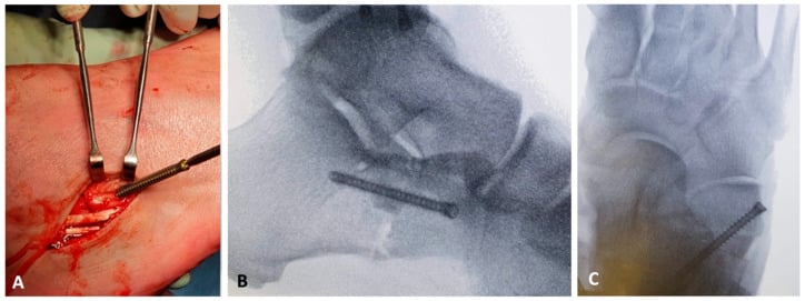 Lateral calcaneal lengthening graft fixation with screw and postoperative AP and lateral radiographs