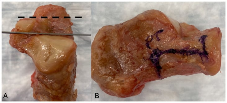 Diagram comparing Evans and sinus tarsi lateral calcaneal lengthening osteotomy locations