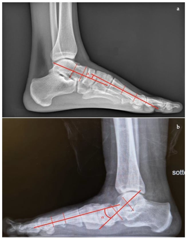 Normal and pathological weight-bearing lateral foot radiographs demonstrating Meary angle