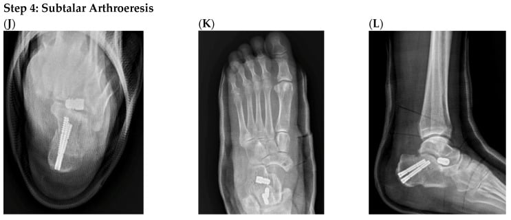 Immediate postoperative weight-bearing radiographs showing correction after four-in-one progressive collapsing foot reconstruction