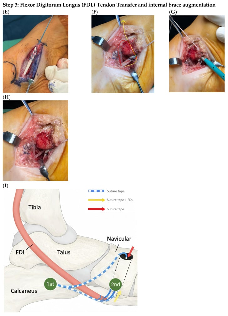 Preoperative clinical photographs and weight-bearing radiographs of flexible progressive collapsing foot deformity