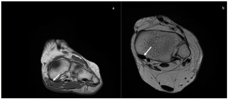 Coronal and axial ankle MRI showing posterior tibial tendon and spring ligament pathology in progressive collapsing foot deformity