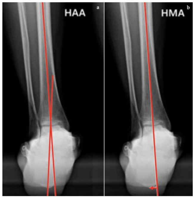 Saltzman hindfoot alignment radiographs demonstrating hindfoot alignment angle and hindfoot moment arm