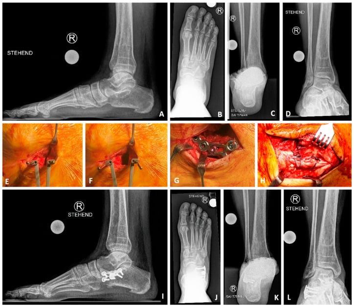 Severe adult pes planovalgus treated with lateral calcaneal lengthening plate and titanium wedge