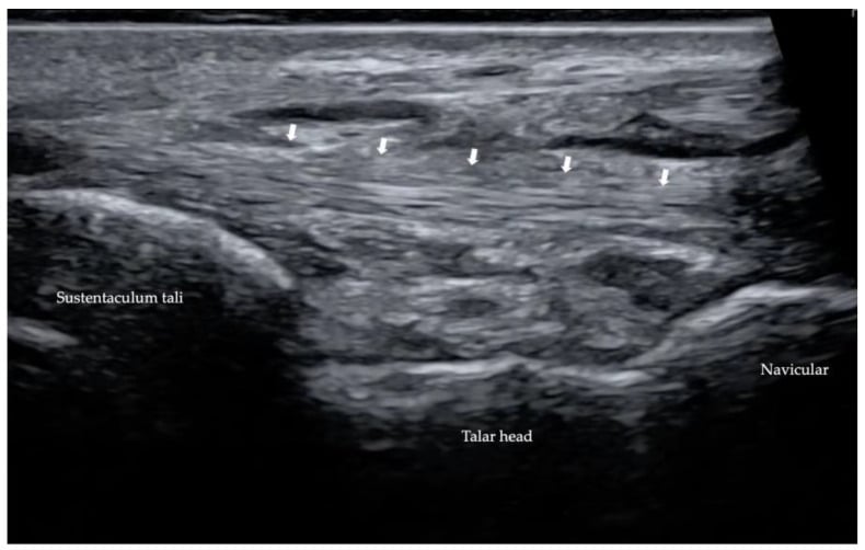 Long-axis ultrasound of the spring ligament between the sustentaculum tali and navicular