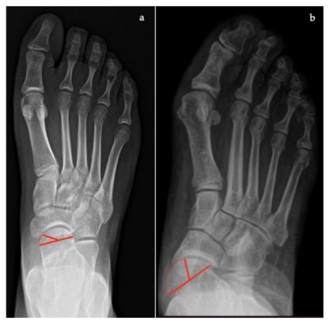 Normal and pathological weight-bearing AP radiographs demonstrating talonavicular uncoverage percentage
