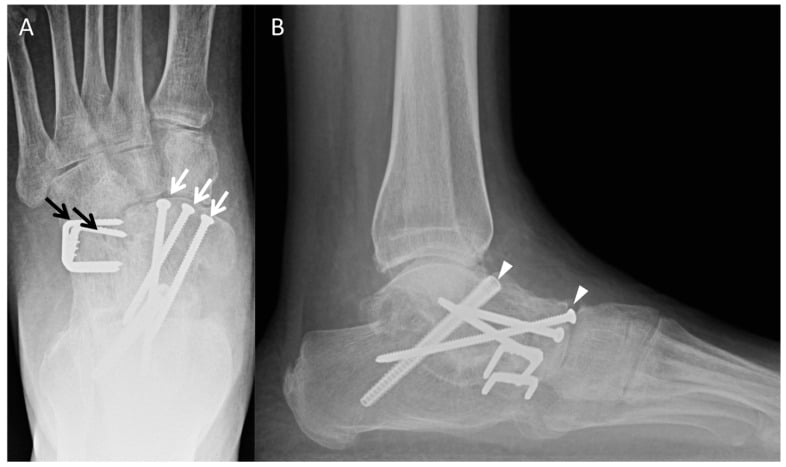 AP and lateral foot radiographs after triple arthrodesis with fixation across subtalar talonavicular and calcaneocuboid joints