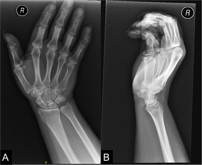 AP and lateral wrist radiographs showing calcific tendinosis at the flexor carpi radialis tendon