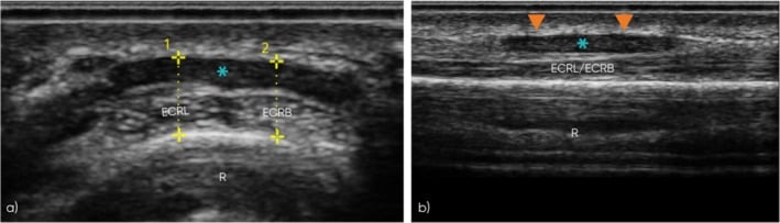 Ultrasound scan of the FCR tendon showing tendon sheath thickening and fluid
