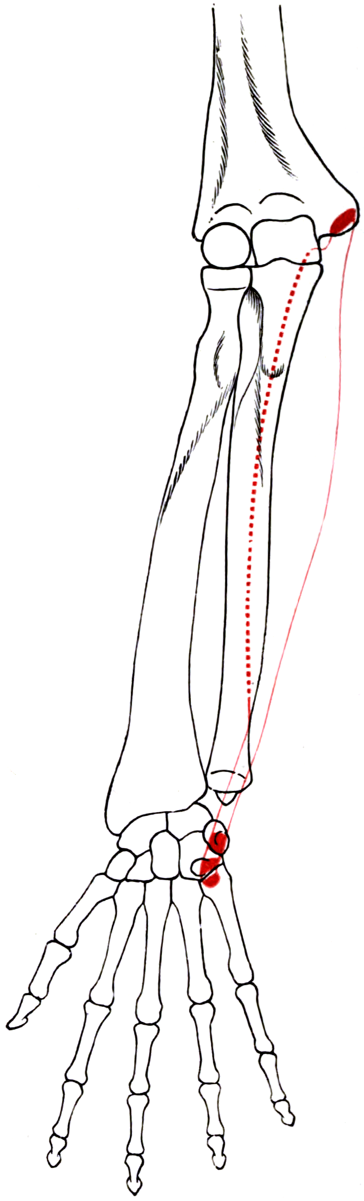 Outline drawing of the right forearm and wrist bones showing the attachment areas of flexor carpi ulnaris.