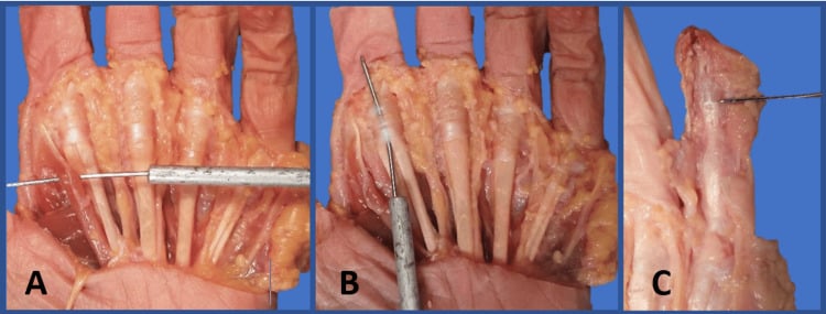 Cadaveric hand dissection showing the first lumbrical, A1 pulley and distal insertion of flexor digitorum profundus.