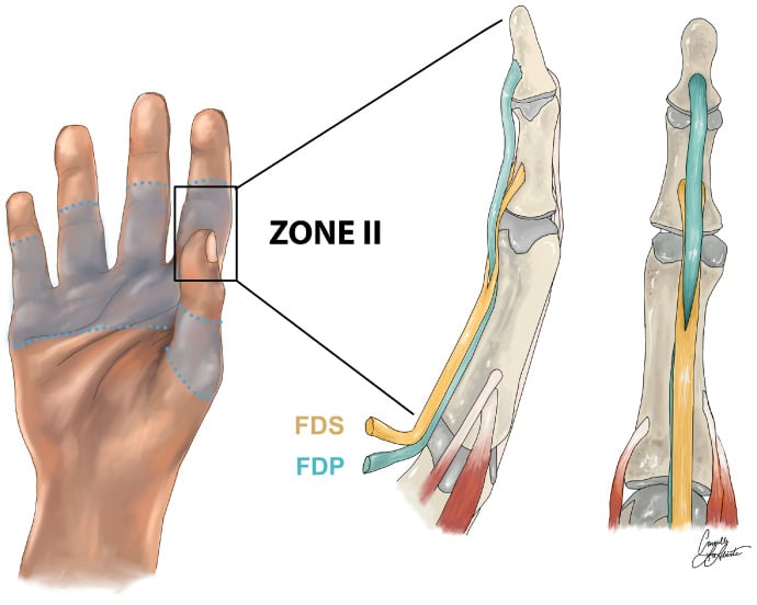 Illustration of zone II showing FDS and FDP tendons within the digital flexor sheath and pulley system.