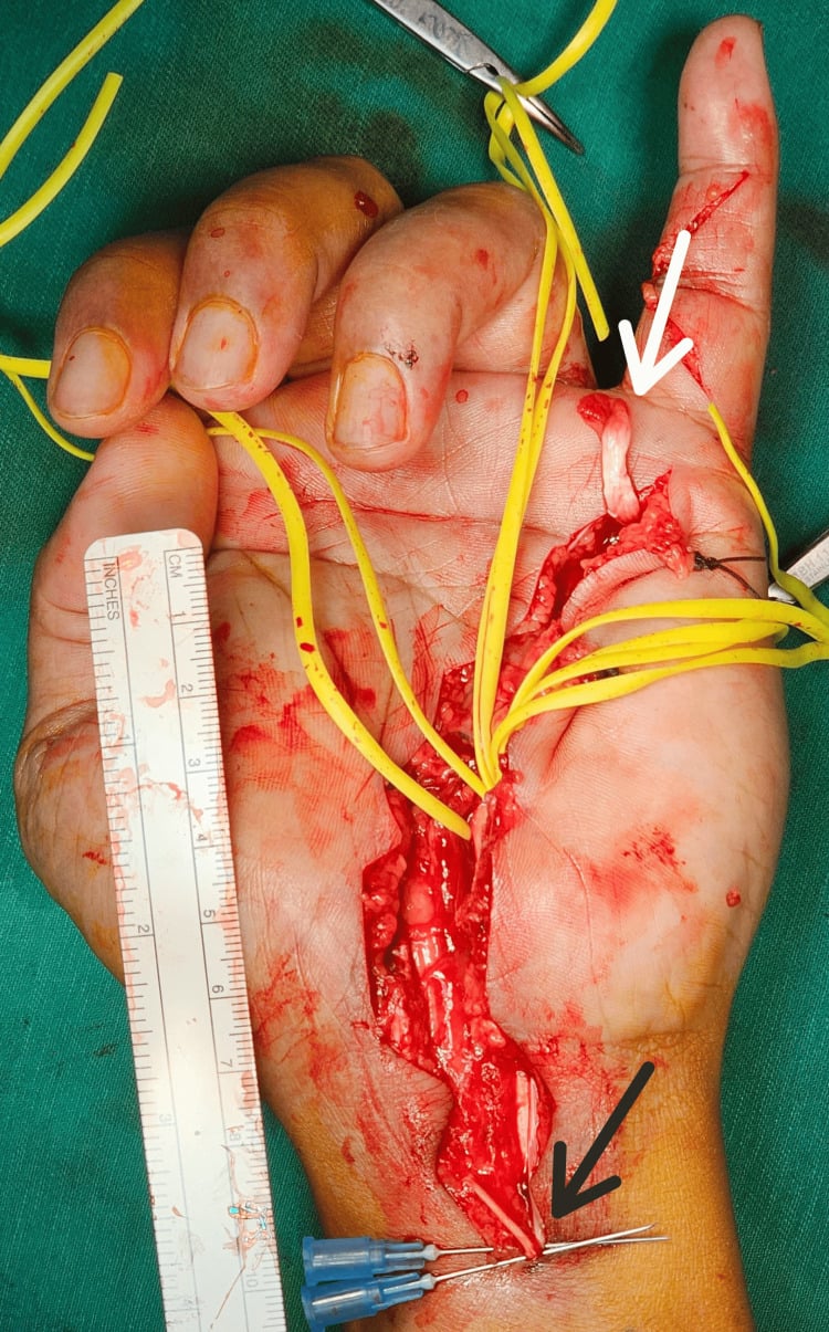 Operative photograph showing widely separated proximal and distal stumps after flexor-tendon rerupture.