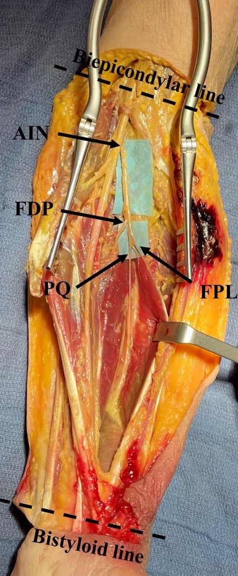 Forearm dissection showing the anterior interosseous nerve and branches to FDP, FPL and pronator quadratus.