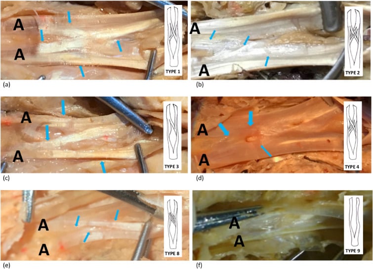 Cadaveric panels showing anatomical variants of Camper chiasm in the digital flexor sheath.
