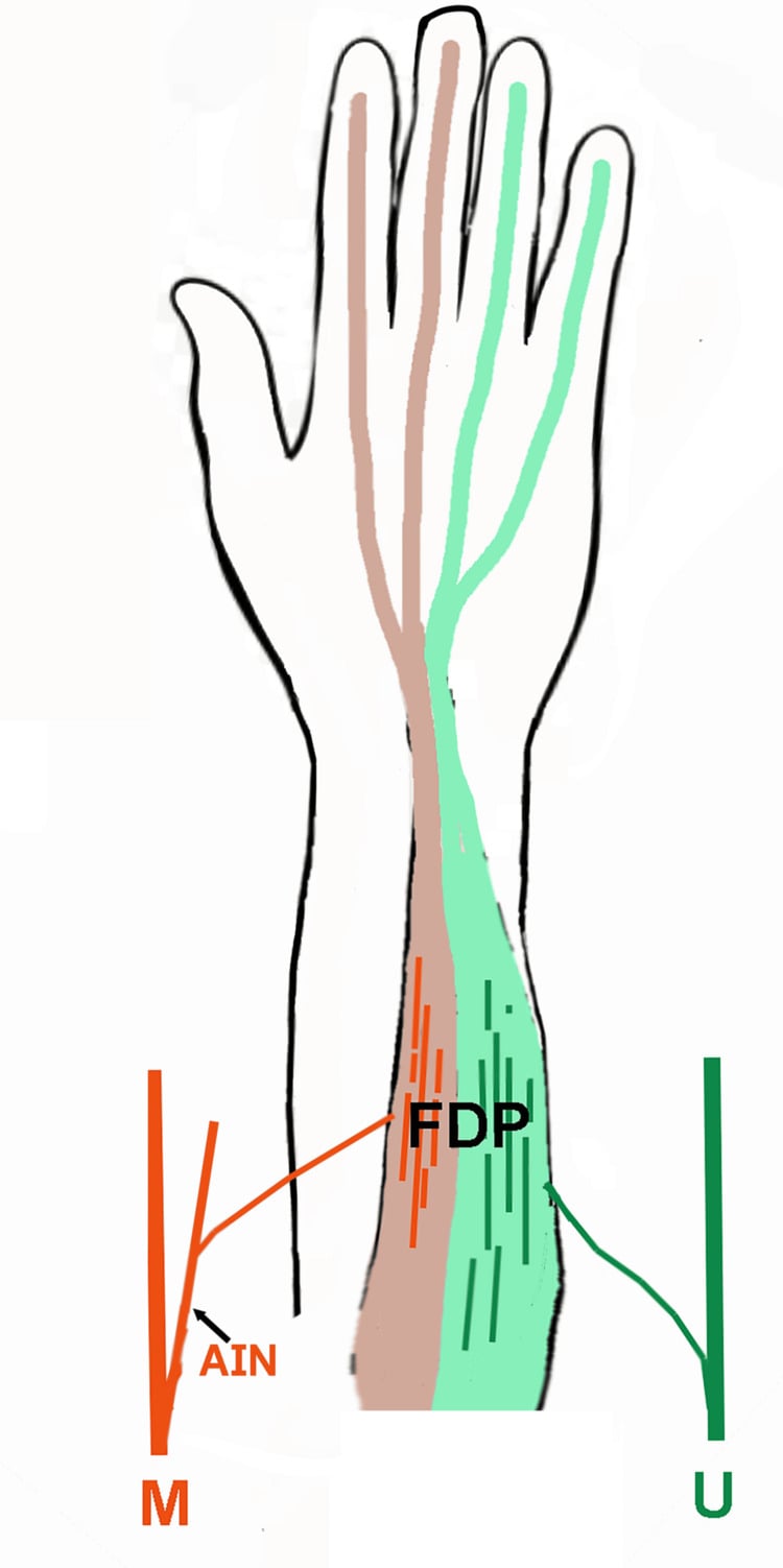 Volar hand diagram showing anterior interosseous and ulnar nerve supply to the radial and ulnar FDP components.