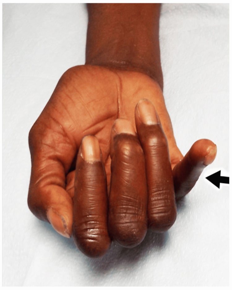 Clinical photograph showing absent small-finger DIP flexion during attempted composite flexion.