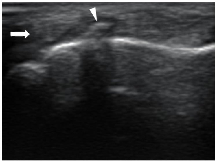 Long-axis ultrasound showing a flexor tendon incarcerated against a proximal-phalanx fracture spike.