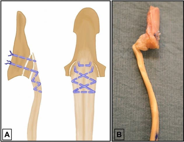 Diagram and cadaveric specimen showing interosseous reattachment of an FDP avulsion with a bony fragment.