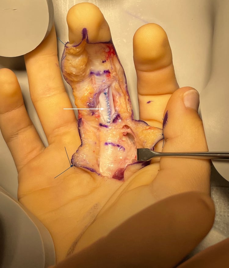 Operative photograph showing suture repair of an intratendinous FDP tear.