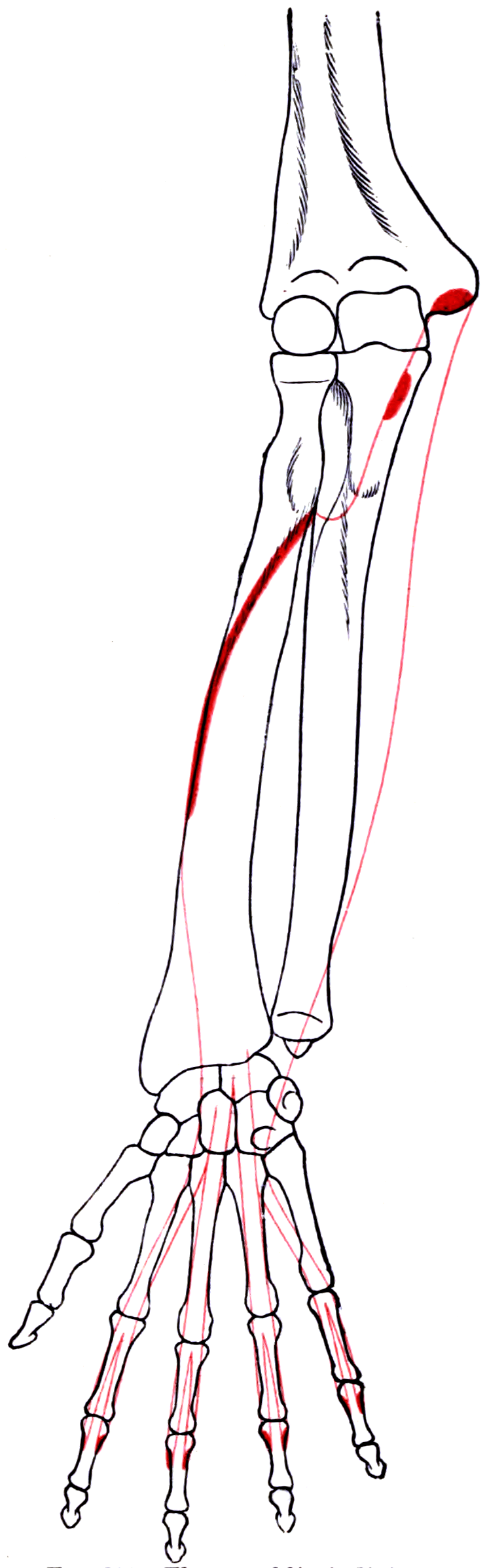 Diagram of the right forearm bones with the outline of flexor digitorum superficialis and its bony attachment areas marked.