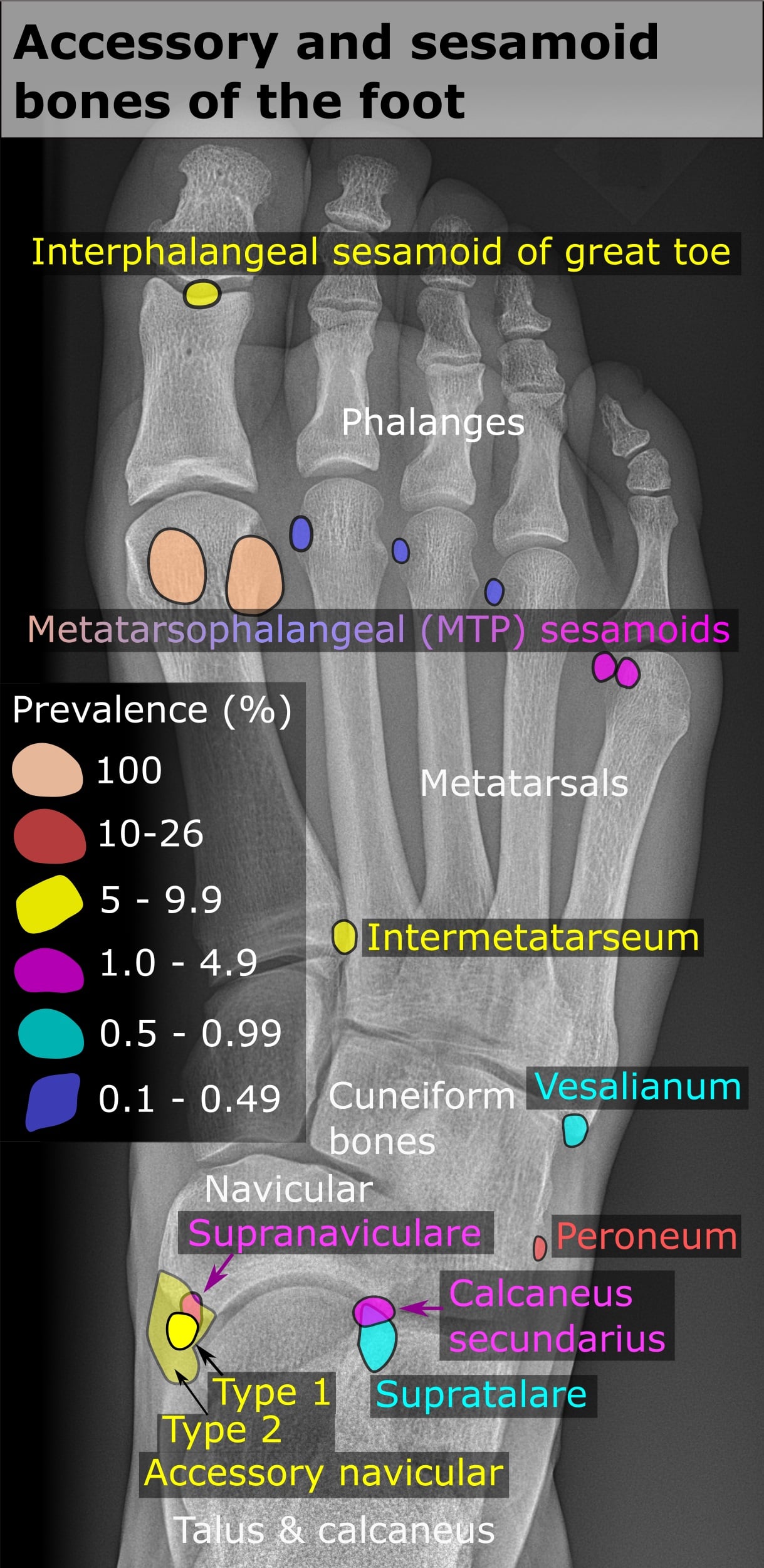 Dorsoplantar radiograph of the right foot with the sites of accessory and sesamoid bones marked in colour according to their prevalence.