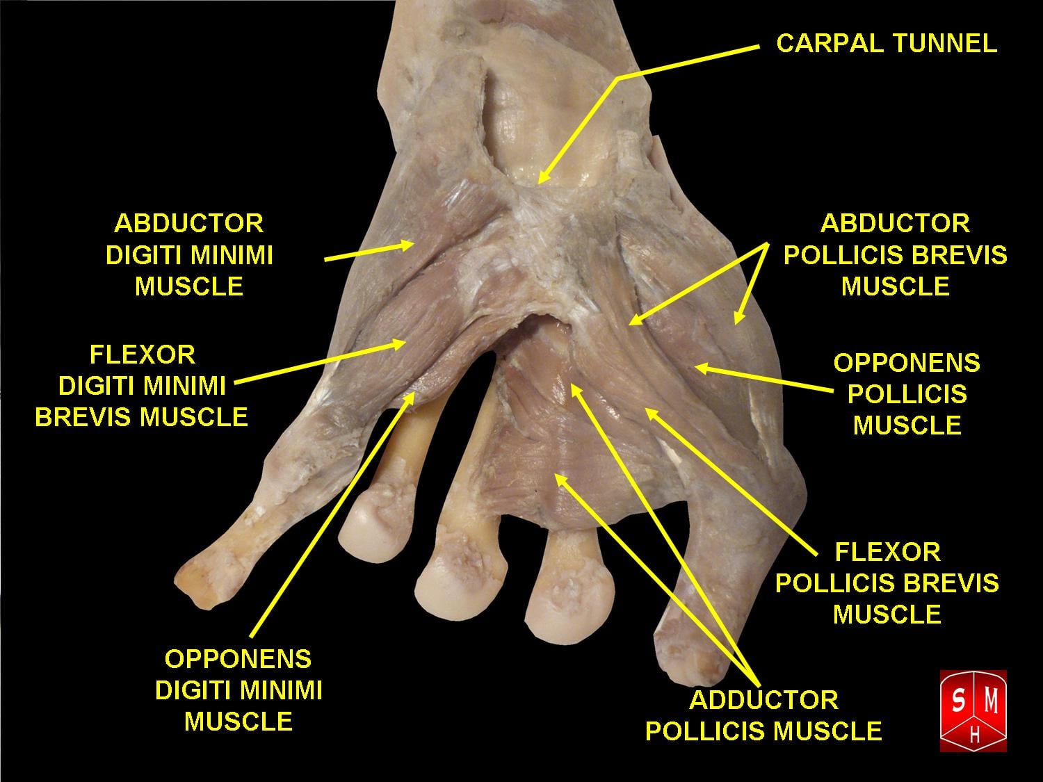 Palmar dissection illustration of the hand showing the thenar and hypothenar muscle groups.